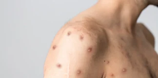 Mpox no Rio de Janeiro: casos aumentam sete vezes em apenas dois meses