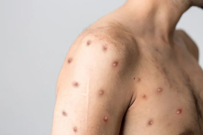 Mpox no Rio de Janeiro: casos aumentam sete vezes em apenas dois meses